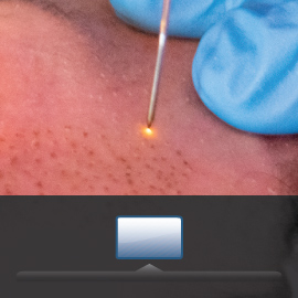 continuos mode plasma blefaroplastic