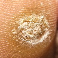 Verruche trattamento plasmage